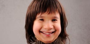 sindrome-williams_0 (1)